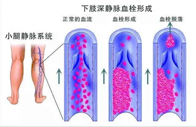 產婦「坐月子」差點截肢！注意：四種月子「坐」不得！