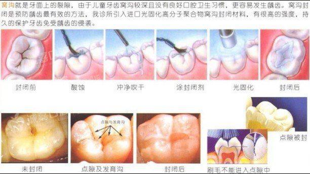 孩子蛀牙都是父母的錯，為啥不帶娃去做窩溝封閉！