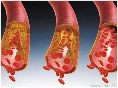 保血管就是保命！ 幾個方法教你血管健康又暢通！