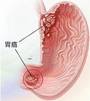 如果你也有這些症狀，請早點去醫院做個胃鏡