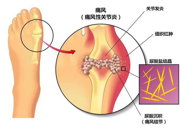 尿酸高，離痛風有多遠？ 做好“三多二少一禁”，能降低尿酸！