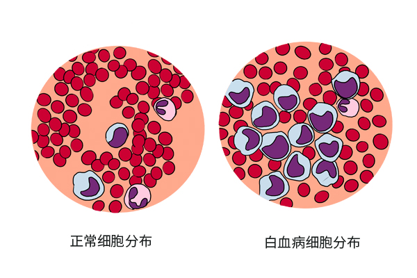 白血病和家裡的環境有關嗎？ 如果孩子出現4種症狀，需要重視