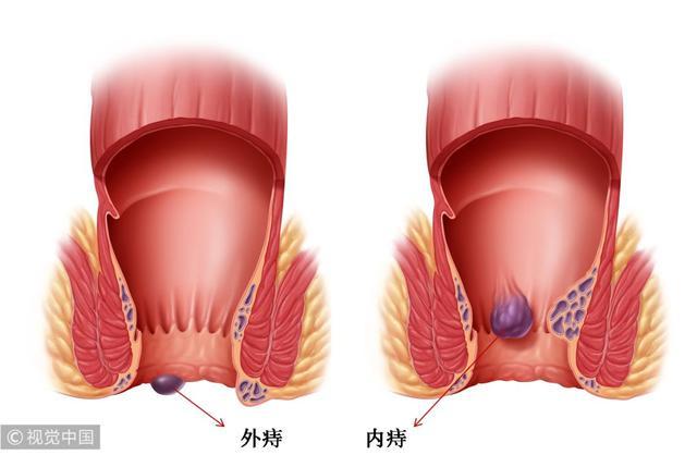 “十人九痔”，必須重視！ 4個妙招助你遠離痔瘡，早知道少遭罪